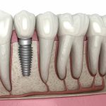 Handling Tooth Avulsion Quickly & Safely