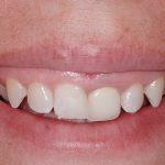 Cosmetic Dentistry in Fresno: Get Better Smile