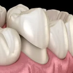 The Dentist’s Role in Treating Sleep Apnea