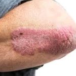 Common Ailments Treated by Acupuncture