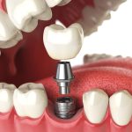 Cosmetic Dentistry Price Guide: Know the Costs
