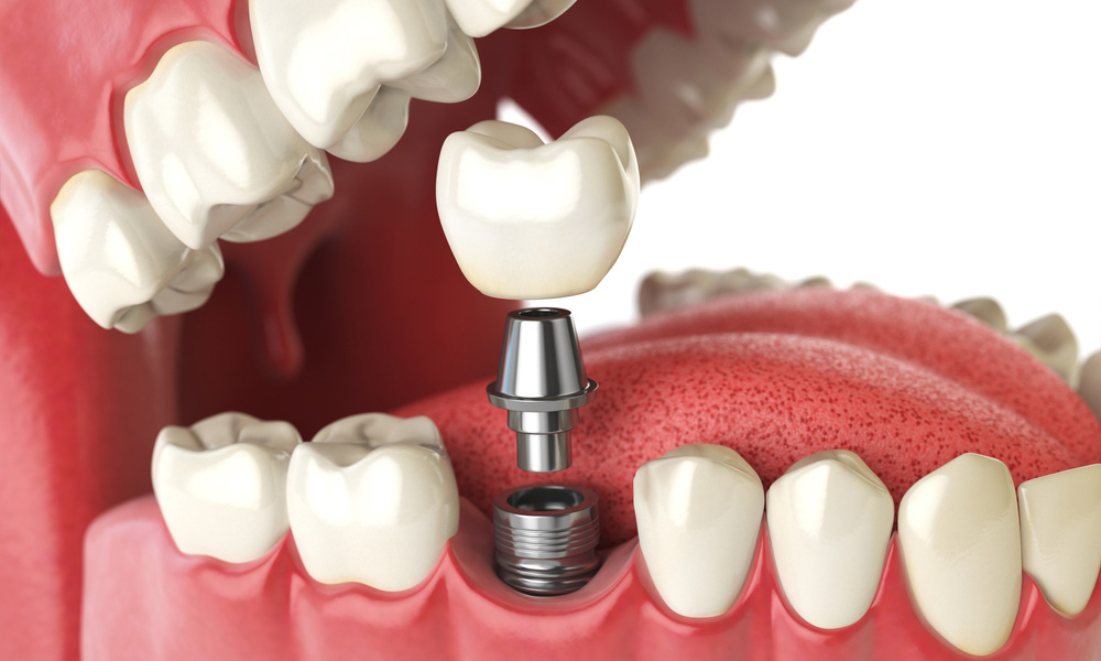 How Long Do Dental Implants Last with Proper Care?