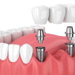 Thread Lift: A Reversible Procedure You Never Regret