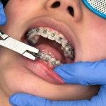 Dental Crowns Restoring Tooth Strength with Care from Dental Anchorage Professionals